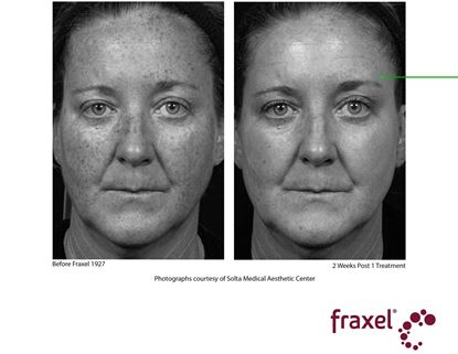 Before and After Image: Fraxel - front