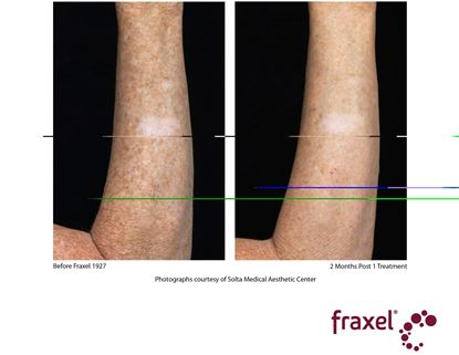 Before and After Image: Fraxel - front
