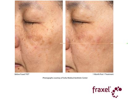 Before and After Image: Fraxel - left-side