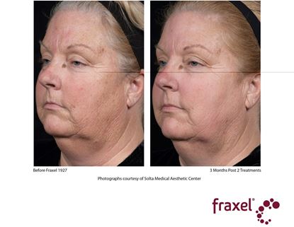 Before and After Image: Fraxel - left-front-oblique