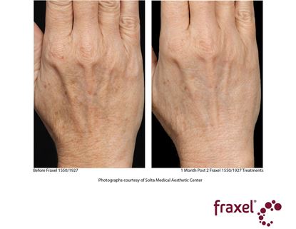 Before and After Image: Fraxel - back