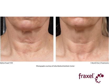 Before and After Image: Fraxel - front