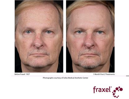Before and After Image: Fraxel - front