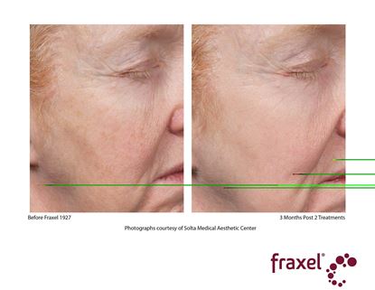 Before and After Image: Fraxel - right-front-oblique