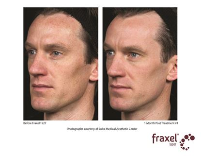 Before and After Image: Fraxel - left-front-oblique
