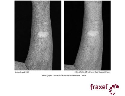 Before and After Image: Flex - front