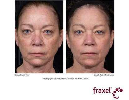 Before and After Image: Flex - front