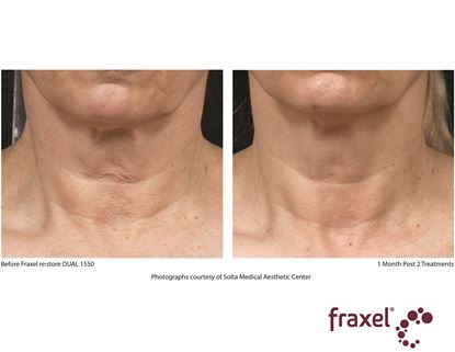 Before and After Image: Fraxel - front