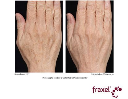 Before and After Image: Fraxel - front