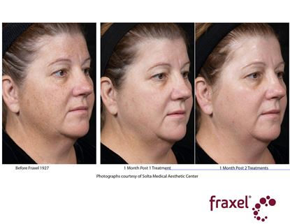 Before and After Image: Fraxel - right-front-oblique