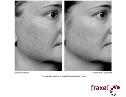 Before and After Image: Fraxel - right-front-oblique