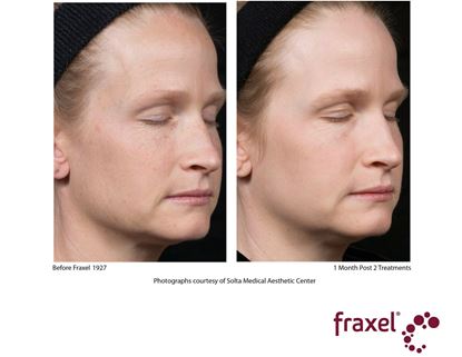 Before and After Image: Fraxel - right-front-oblique