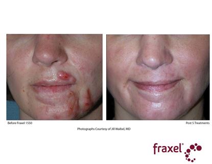 Before and After Image: Fraxel - front