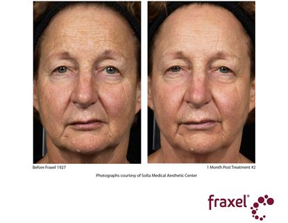Before and After Image: Fraxel - right-front-oblique