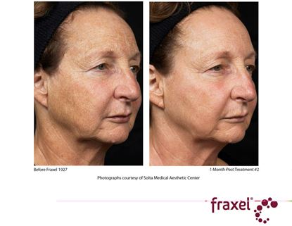 Before and After Image: Fraxel - right-front-oblique