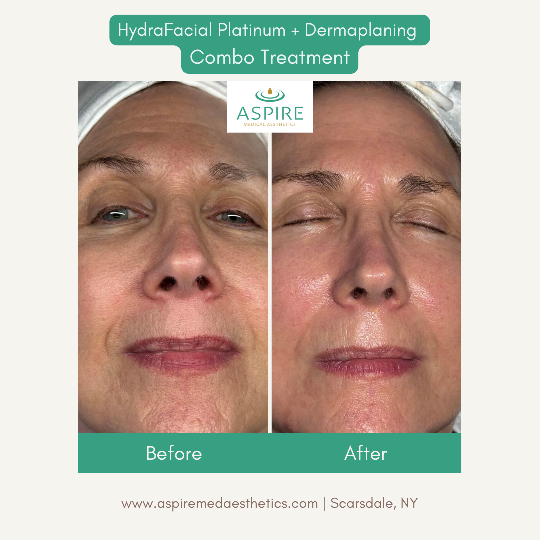 Before and After Image: HydraFacial – Glowing Face - front