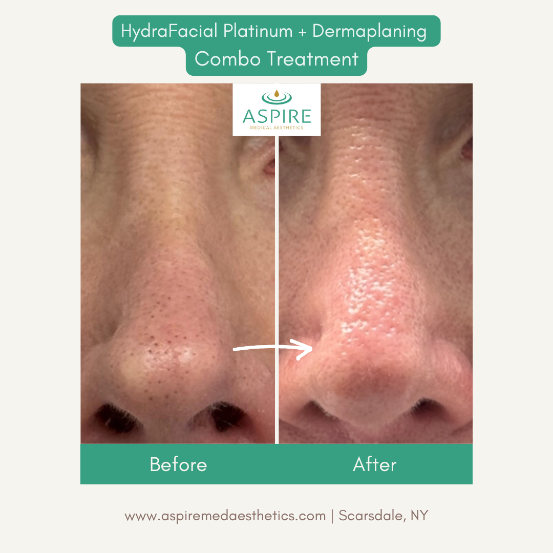 Before and After Image: HydraFacial – Clear Pores - front