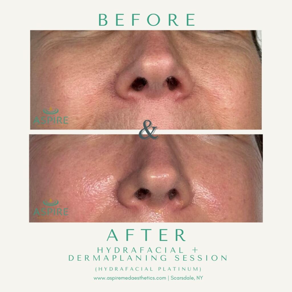 Before and After Image: HydraFacial – Glowing Cheeks - front