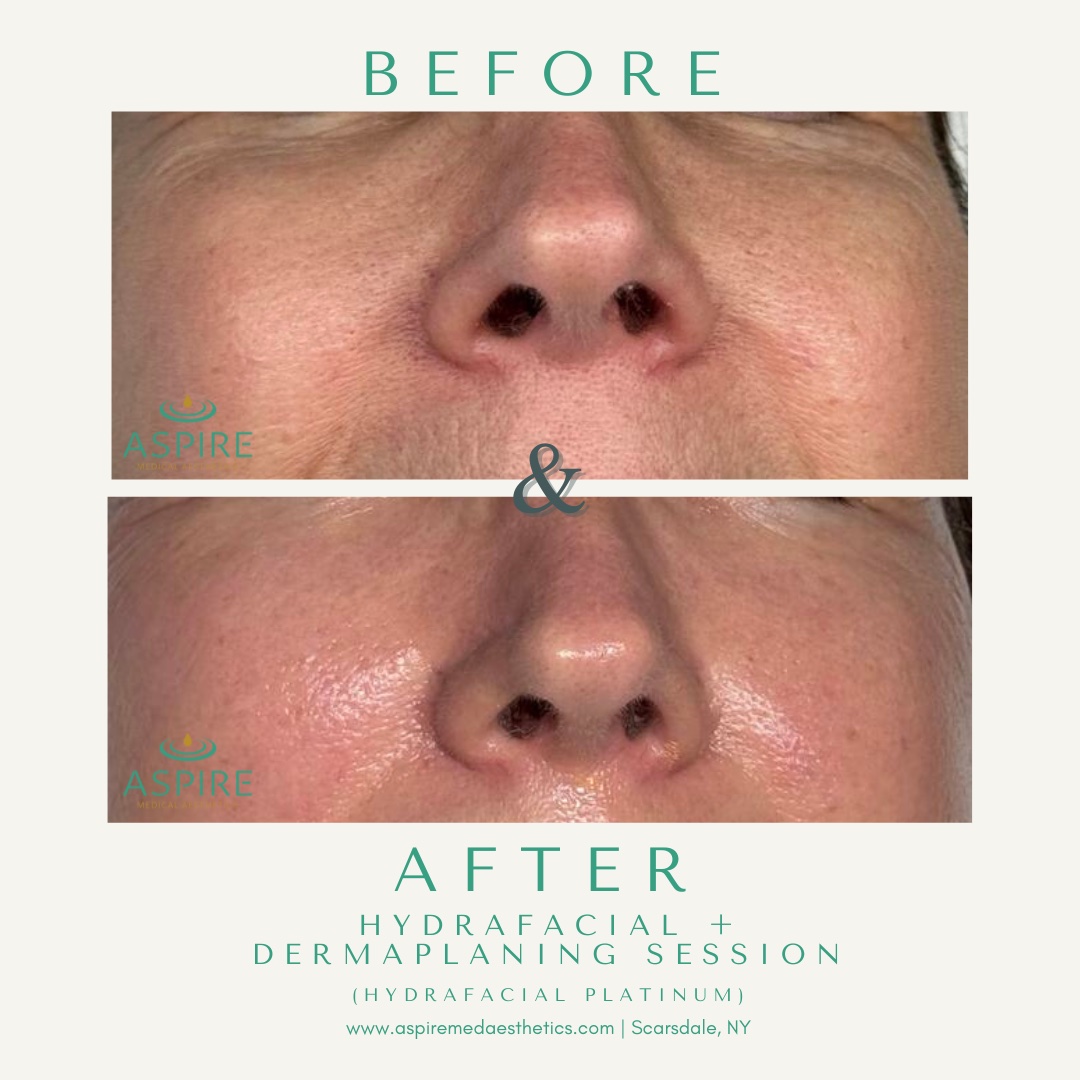 Before and After Image: HydraFacial – Glowing Cheeks - front