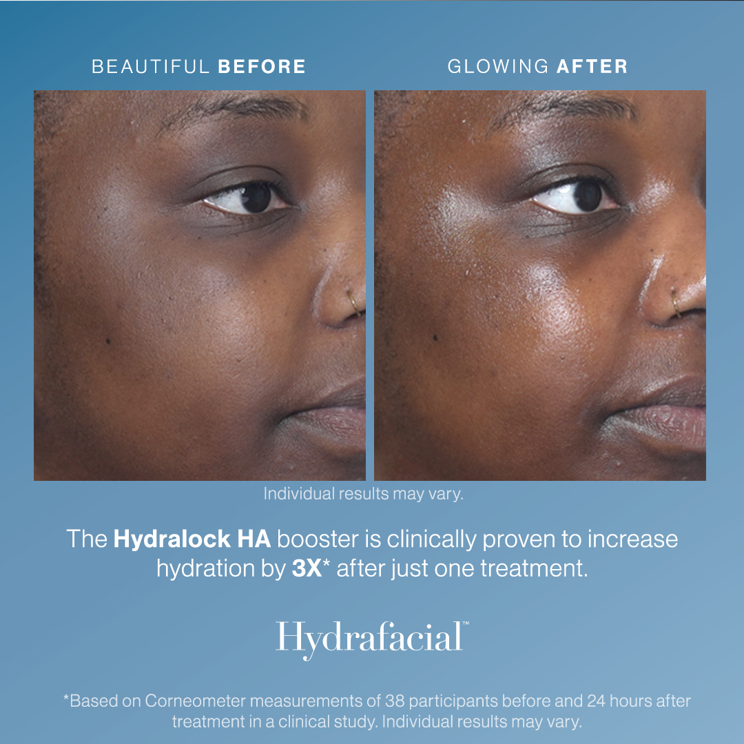 Before and After Image: HydraFacial – Hydralock - right-front-oblique