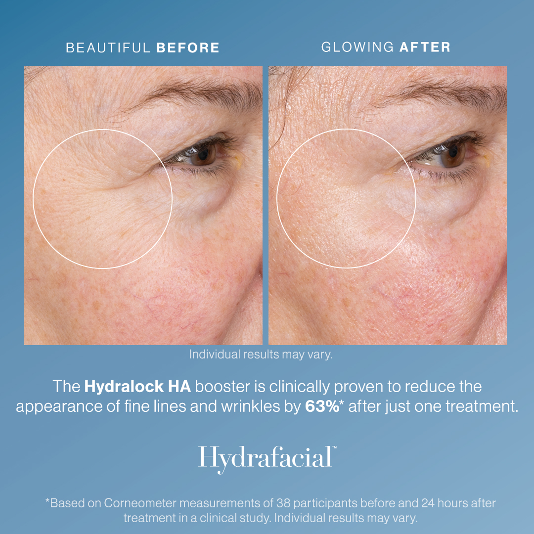 Before and After Image: HydraFacial – Hydralock - right-front-oblique