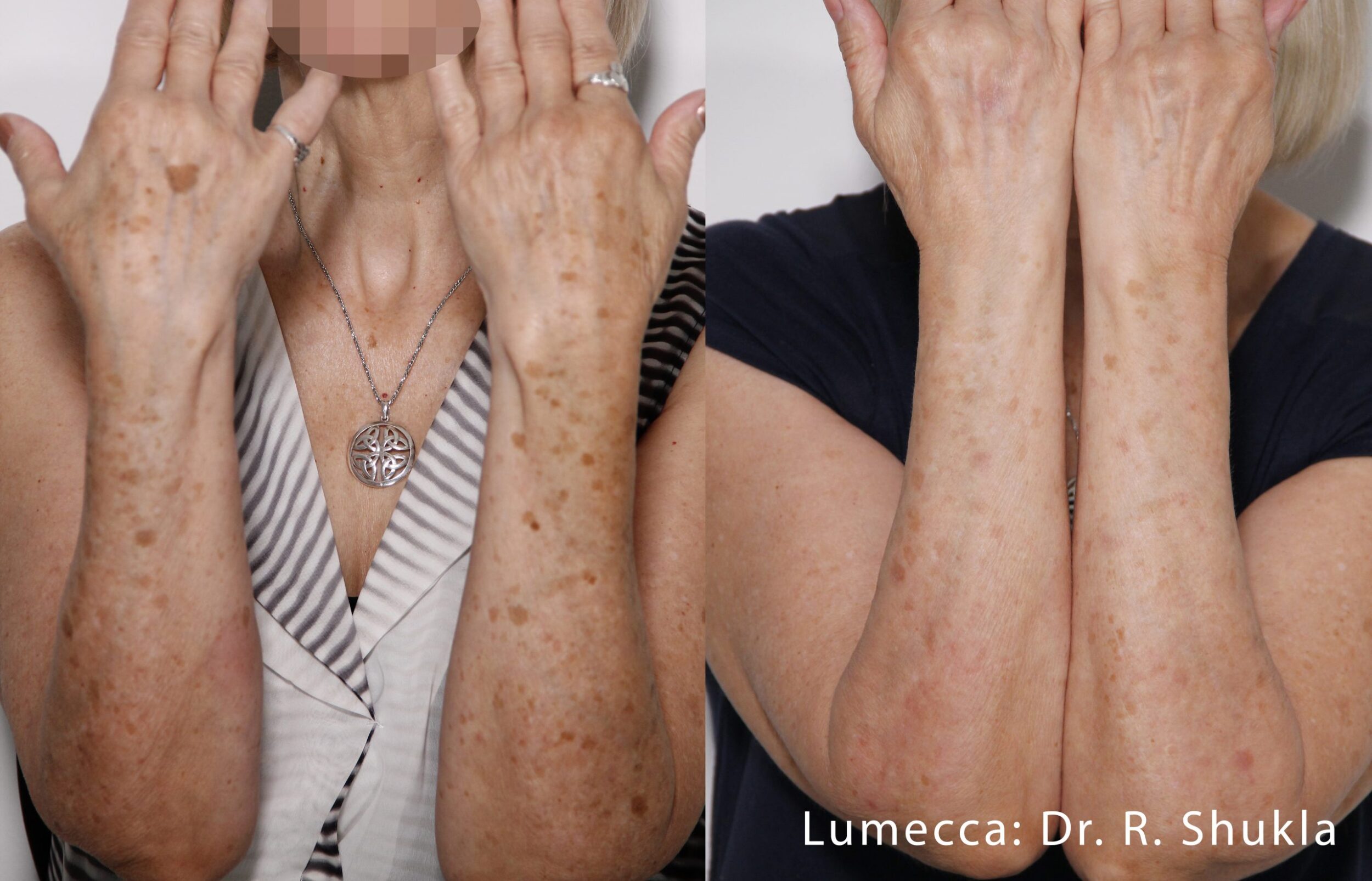 Before and After Image: IPL Brown Spots Arms and Hands - front