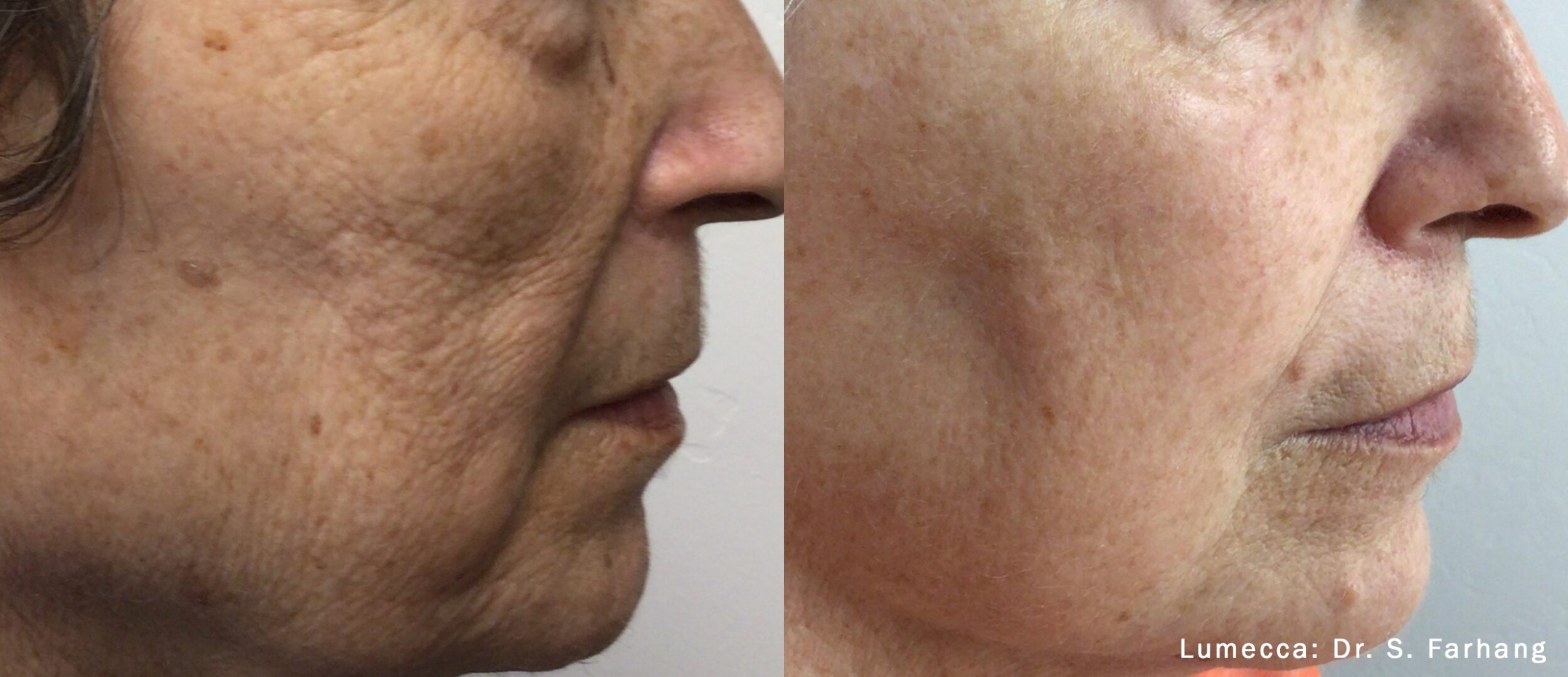 Before and After Image: IPL Brown Spots Face - right-side