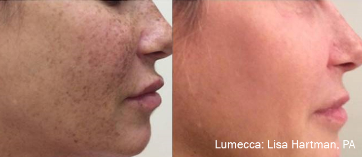 Before and After Image: IPL Brown Spots Face - right-side