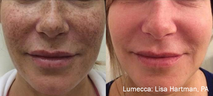 Before and After Image: IPL Brown Spots Face - front
