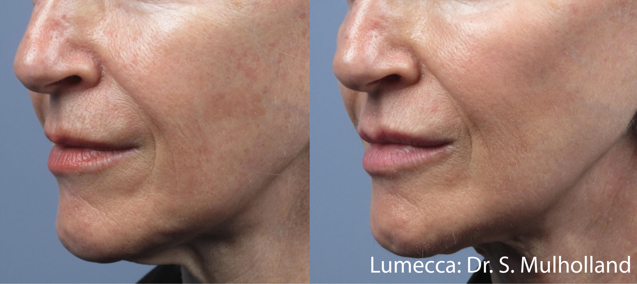 Before and After Image: IPL Brown Spots Face - left-front-oblique