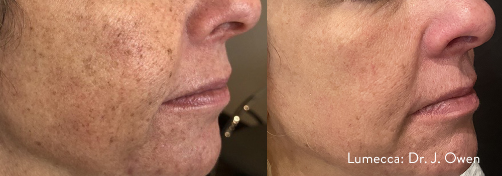 Before and After Image: IPL Brown Spots Face - right-front-oblique