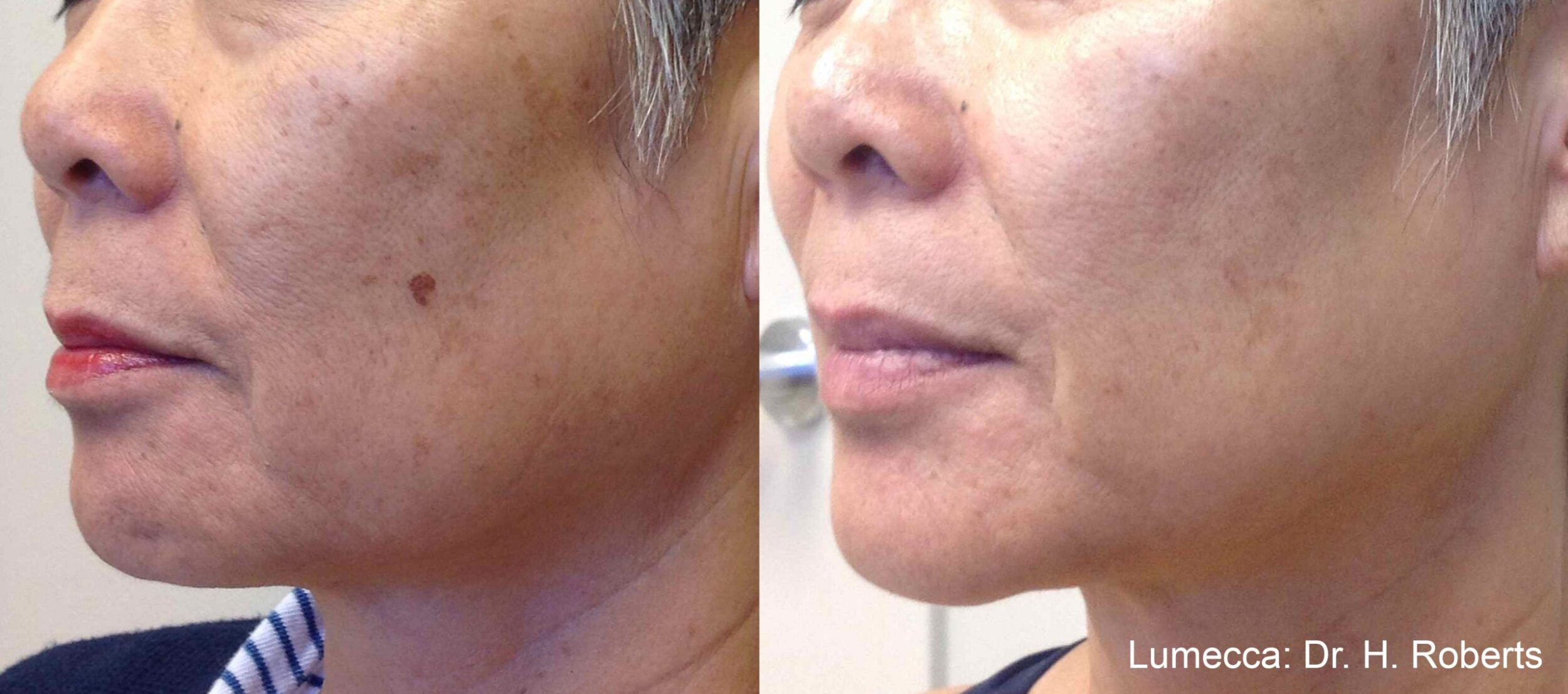 Before and After Image: IPL Brown Spots Face - left-front-oblique