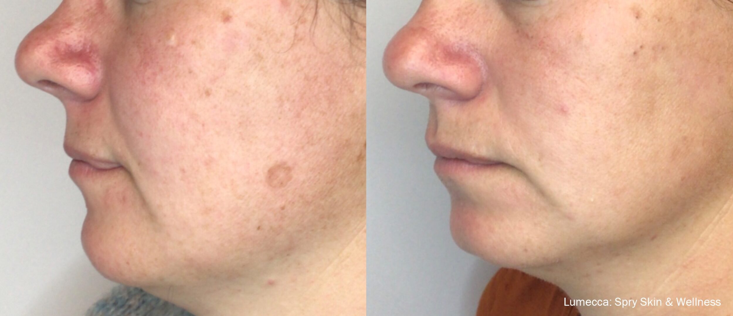 Before and After Image: IPL Brown Spots Face - left-front-oblique