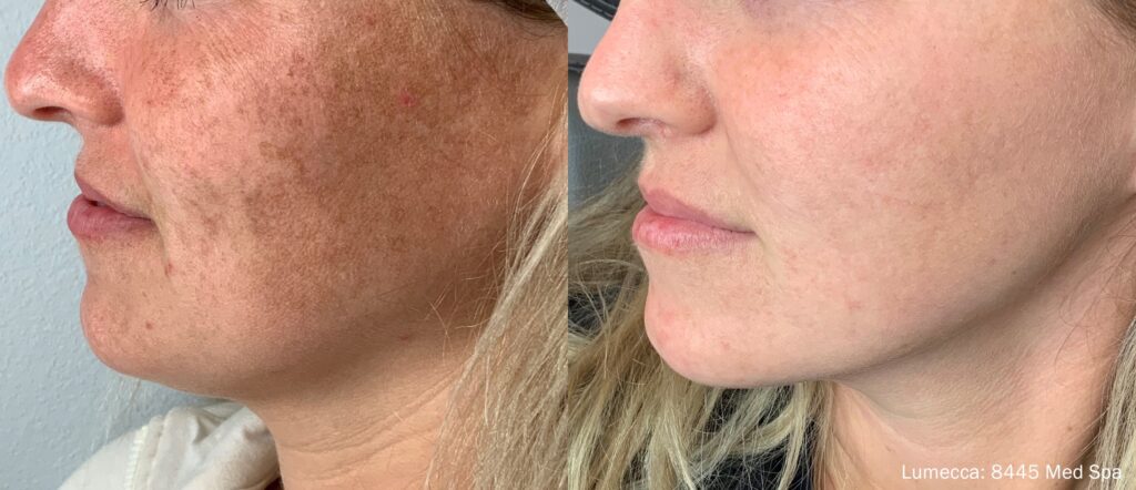 Before and After Image: IPL Brown Spots Face - left-front-oblique