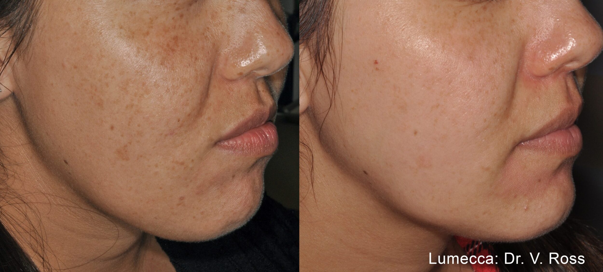 Before and After Image: IPL Brown Spots Face - right-front-oblique