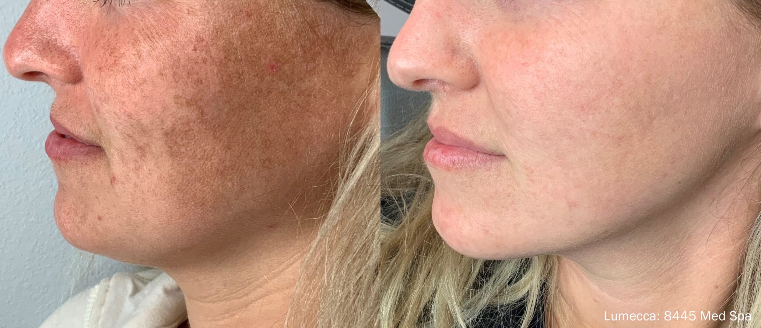 Before and After Image: IPL Brown Spots Face - left-front-oblique