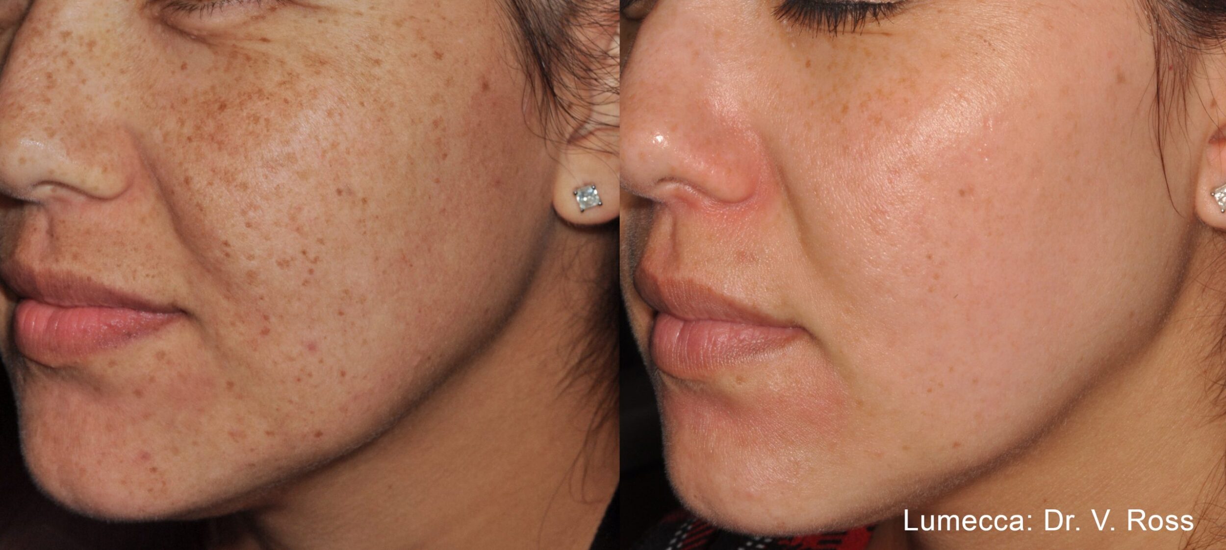Before and After Image: IPL Brown Spots Face - left-front-oblique