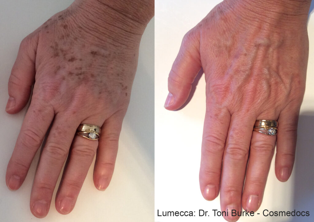 Before and After Image: IPL Brown Spots Hands - front