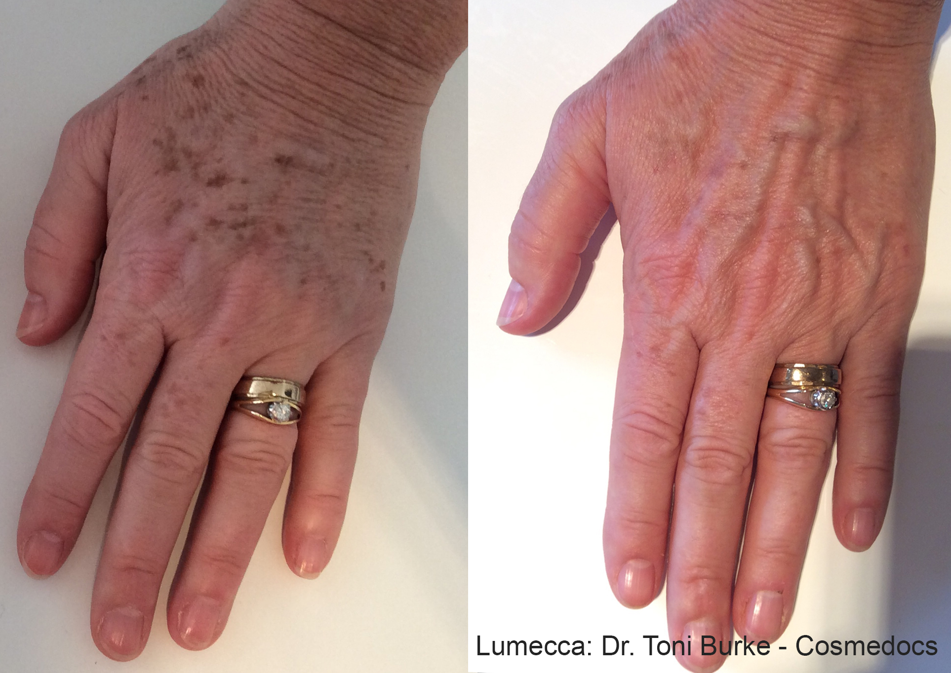 Before and After Image: IPL Brown Spots Hands - front