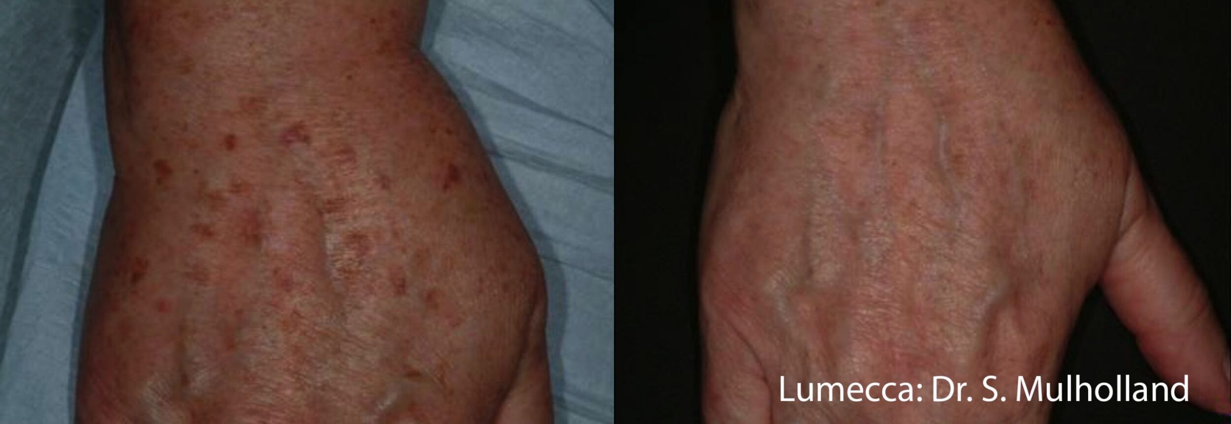 Before and After Image: IPL Brown Spots Hands - front