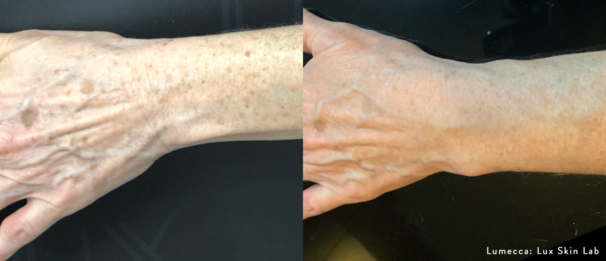 Before and After Image: IPL Brown Spots Hands - front