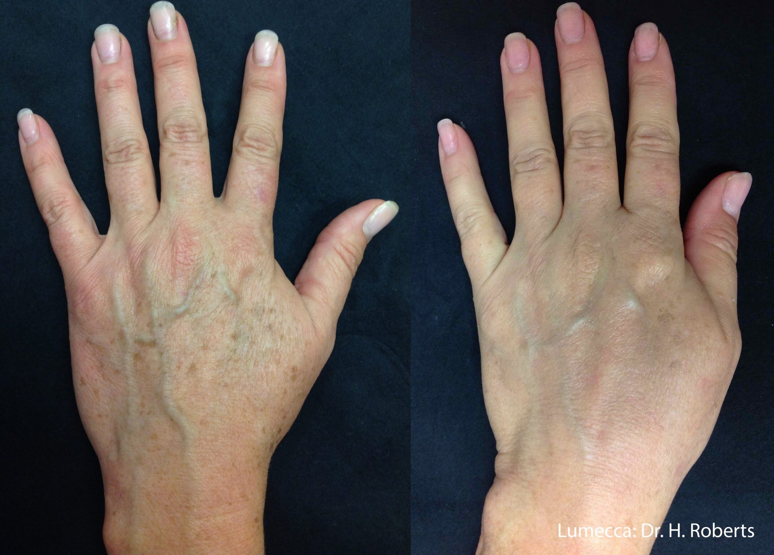 Before and After Image: IPL Brown Spots Hands - front