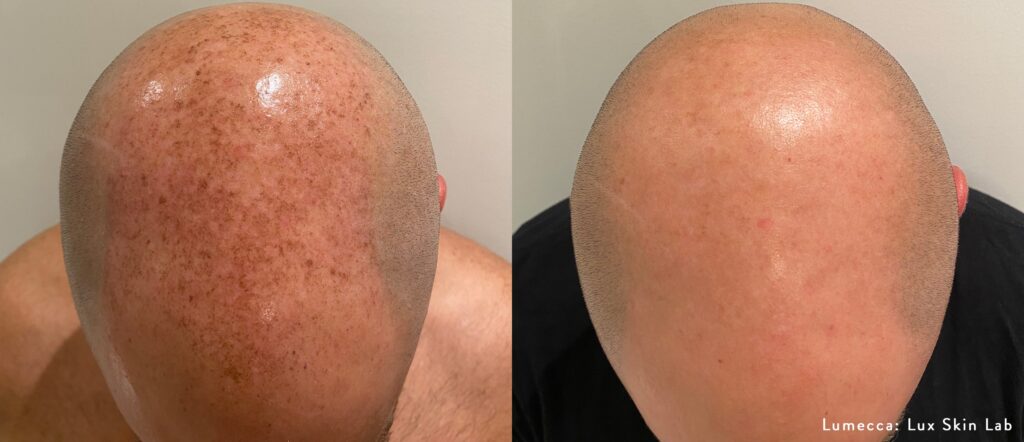 Before and After Image: IPL Brown Spots Head - front