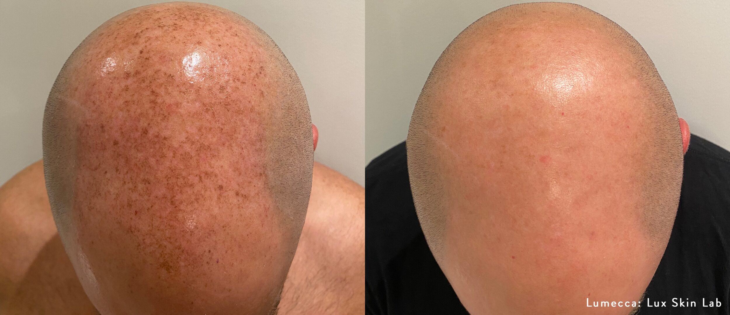 Before and After Image: IPL Brown Spots Head - front