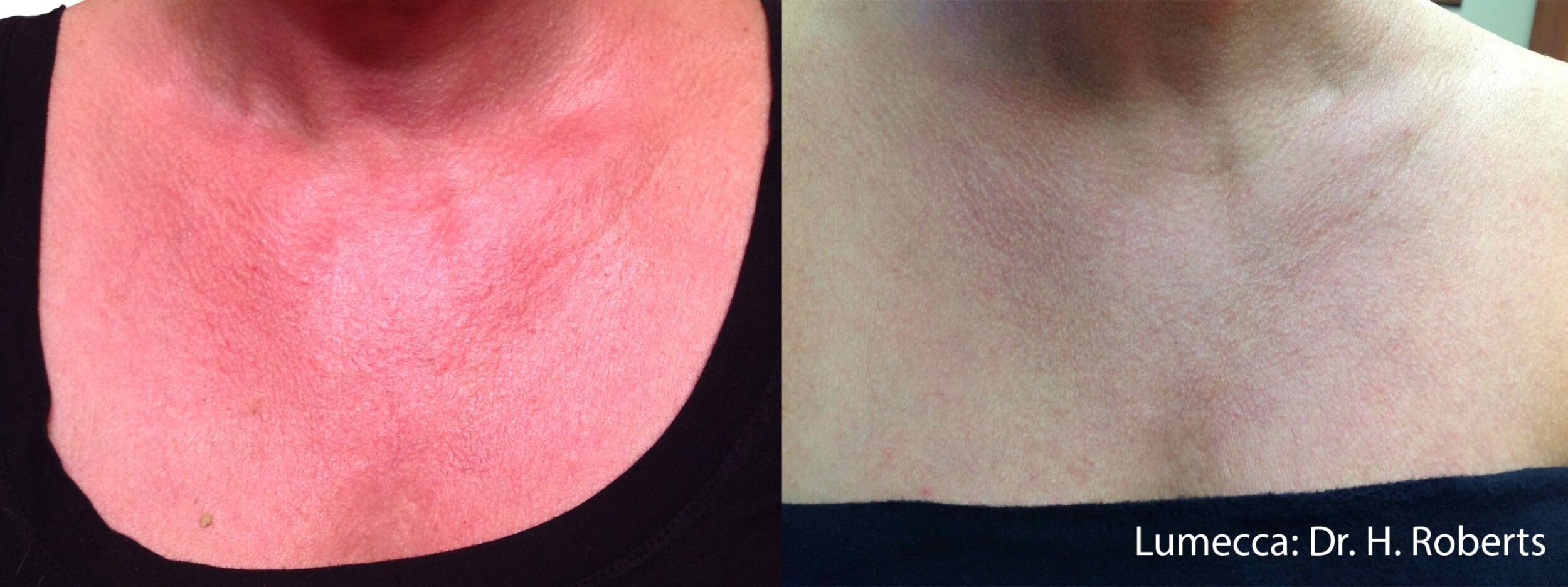 Before and After Image: Red Spots and Vessels - front