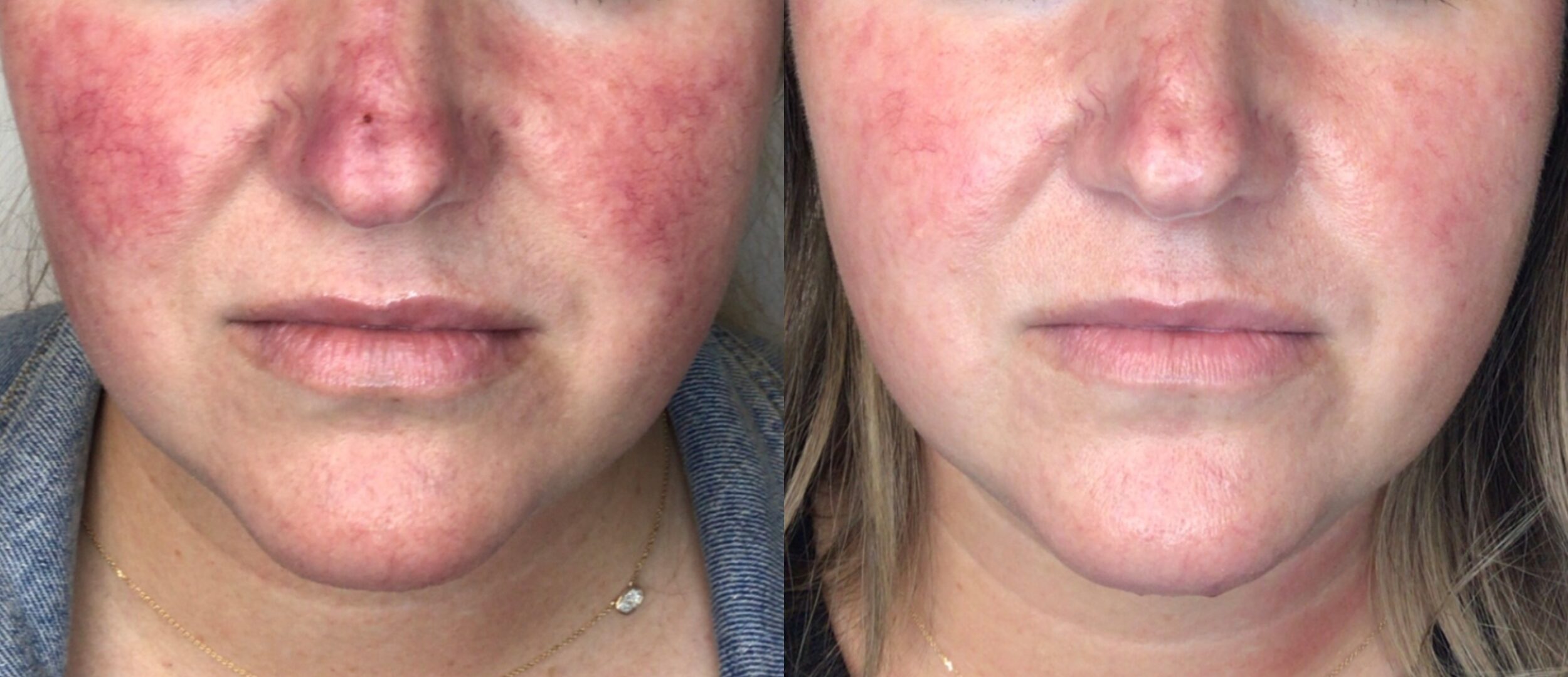 Before and After Image: Red Spots and Vessels - front