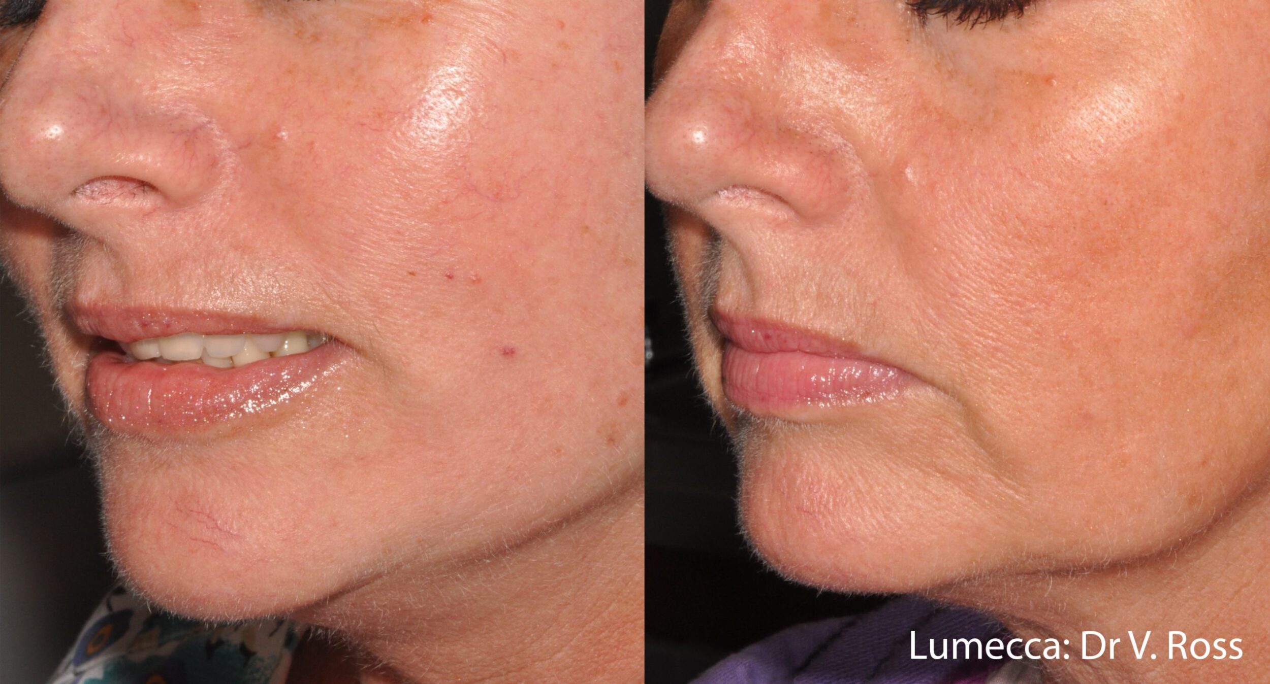 Before and After Image: Red Spots and Vessels - left-front-oblique