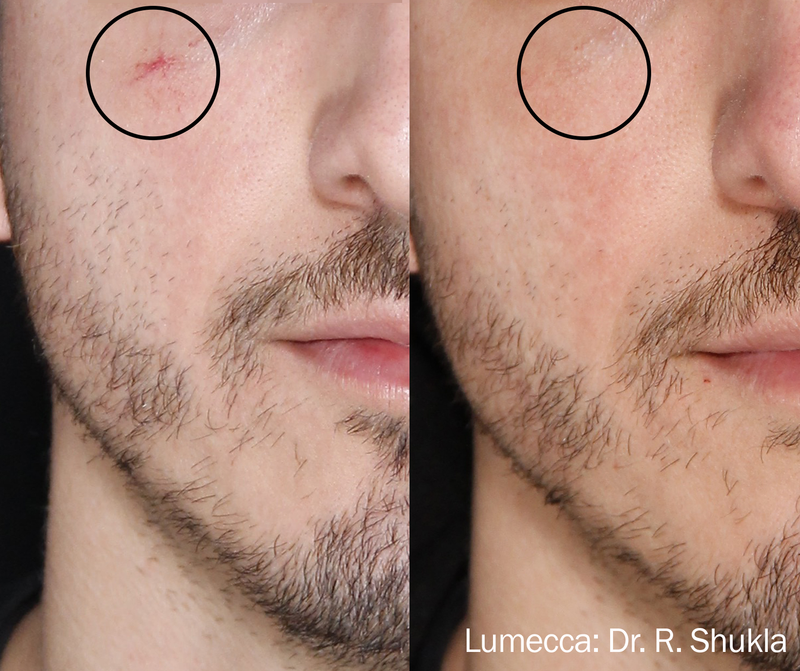Before and After Image: Red Spots and Vessels - front