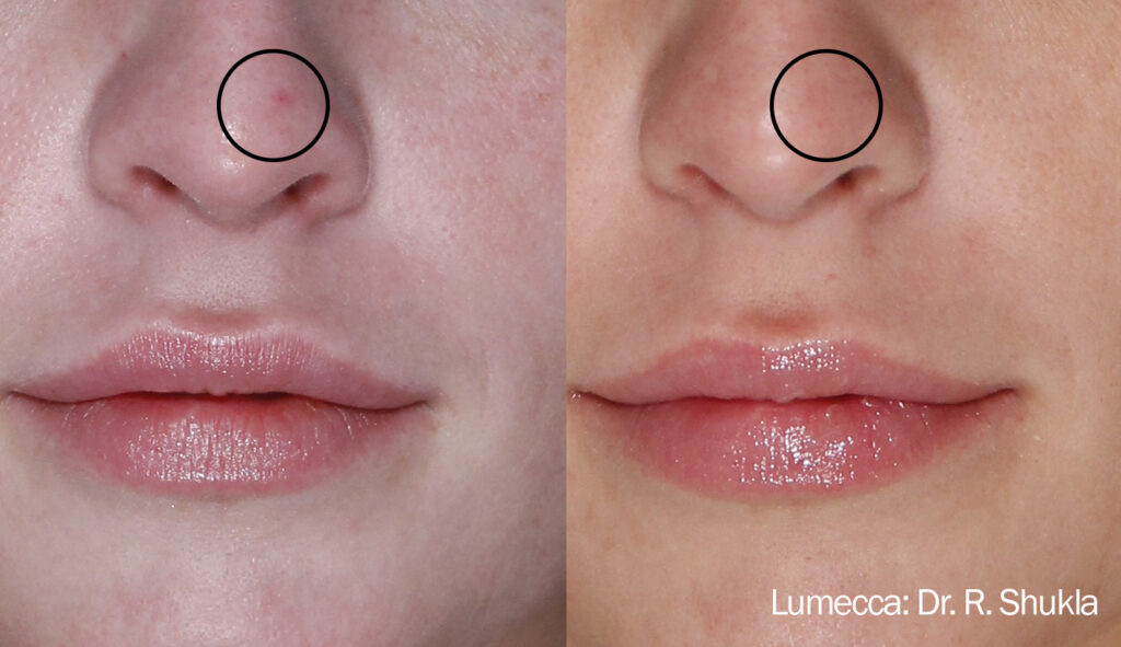 Before and After Image: Red Spots and Vessels - front