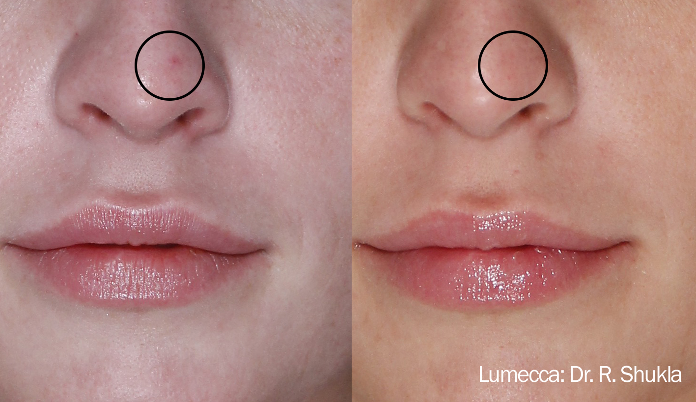 Before and After Image: Red Spots and Vessels - front
